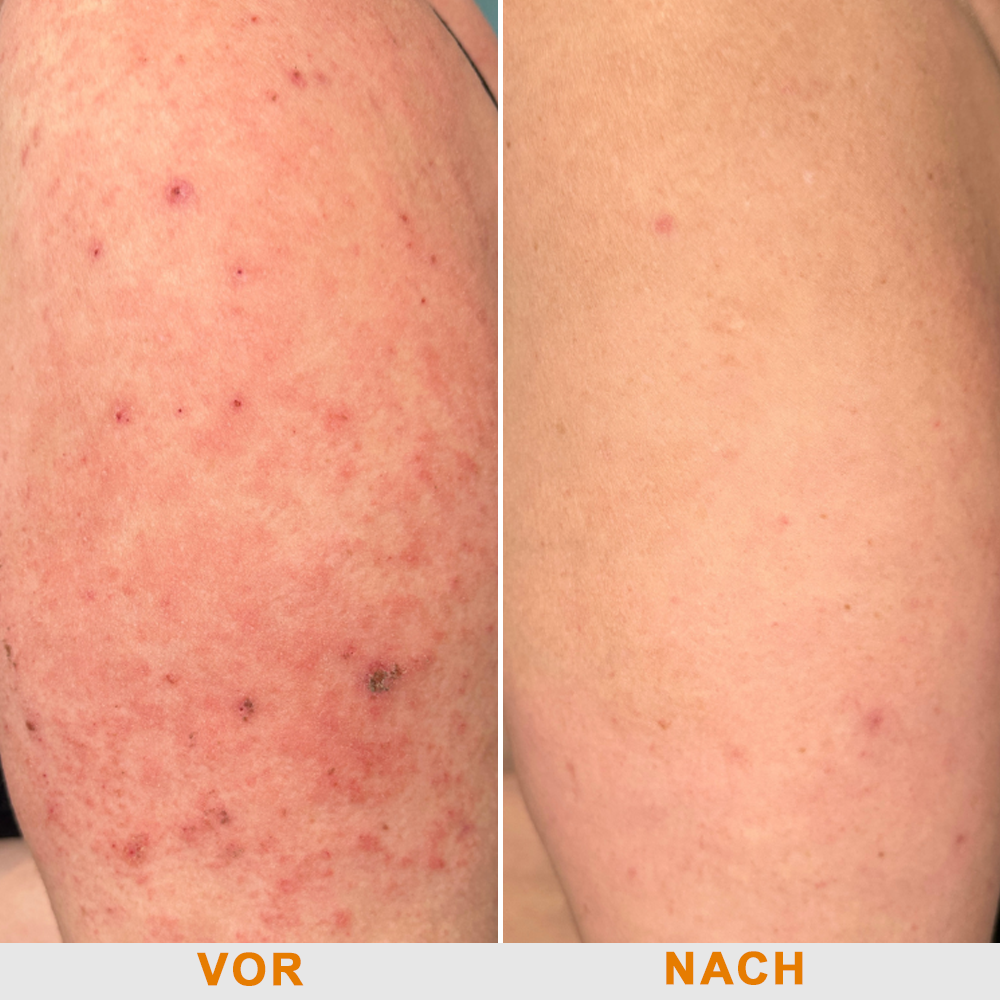 Offizieller Shop: Ourlyard® Bienengift Hautbehandlungscrem👨‍⚕️Von der Deutschen Gesellschaft für Dermatologie (DDG) genehmigt
