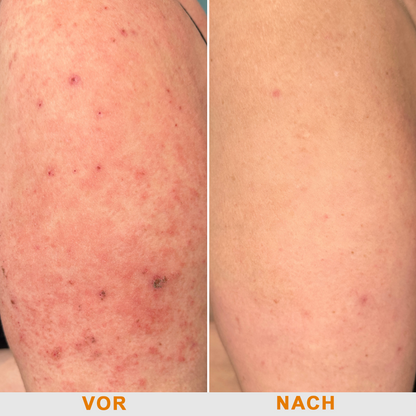 Offizieller Shop: Ourlyard® Bienengift Hautbehandlungscrem👨‍⚕️Von der Deutschen Gesellschaft für Dermatologie (DDG) genehmigt
