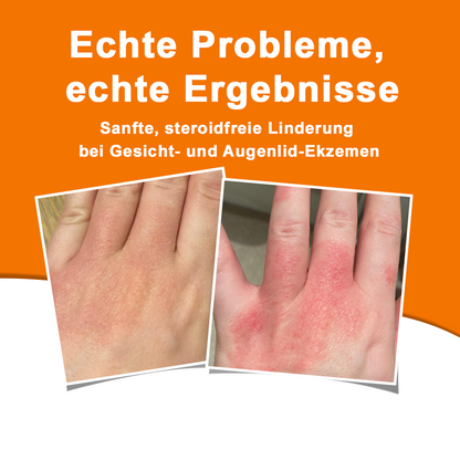 Offizieller Shop: Ourlyard® Bienengift Hautbehandlungscrem👨‍⚕️Von der Deutschen Gesellschaft für Dermatologie (DDG) genehmigt